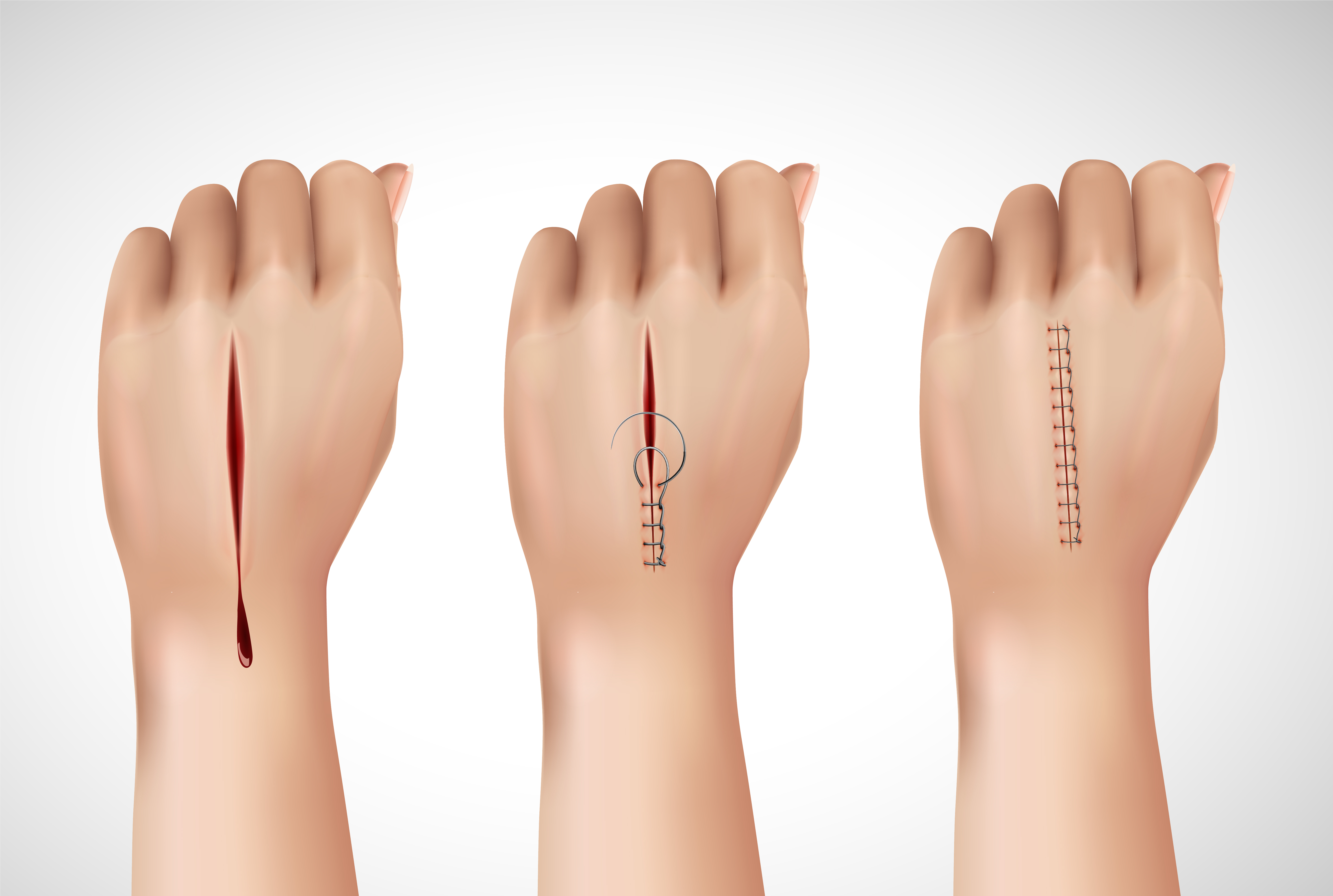 Surgical Suture 3